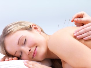 Acupuncture needles on the back of a beautiful woman
